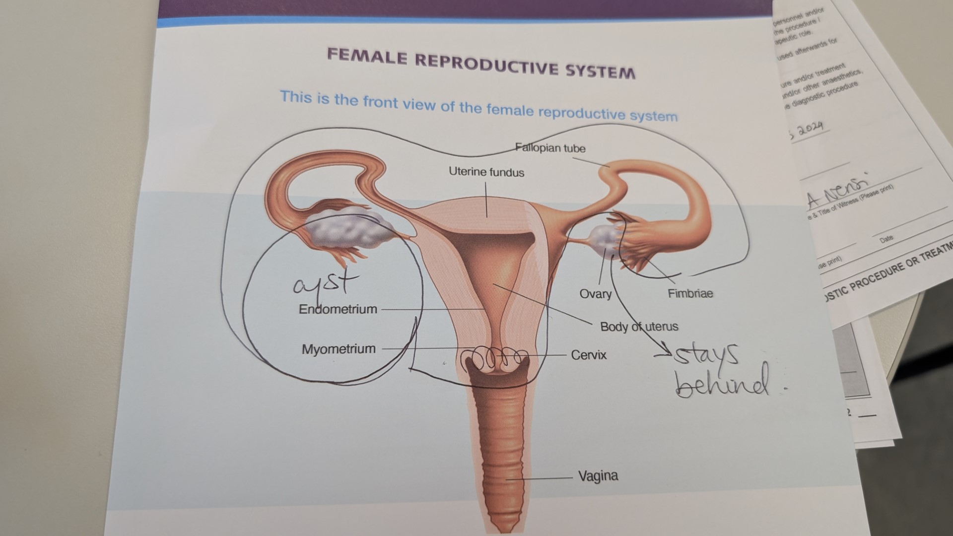 Hysterectomy Toronto